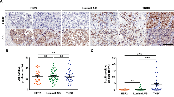 SOX10 histochemistry can be used as a predictor of TNBC.