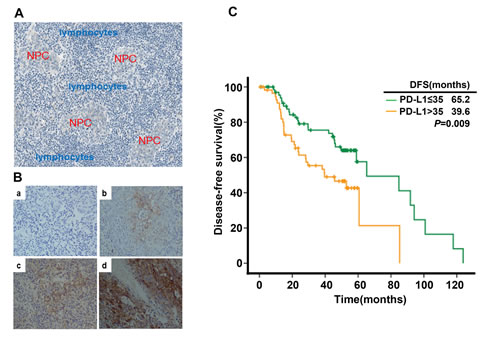 PD-L1 expression in tumor tissue samples and its correlation with recurrence free survival in nasopharyngeal carcinoma patients.