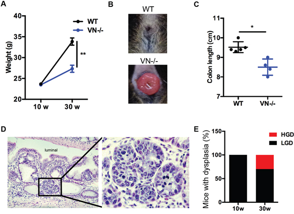 Chronic Notch-1 deficiency in intestinal epithelial cells worsens spontaneous intestinal pathology and causes high grade dysplasia.