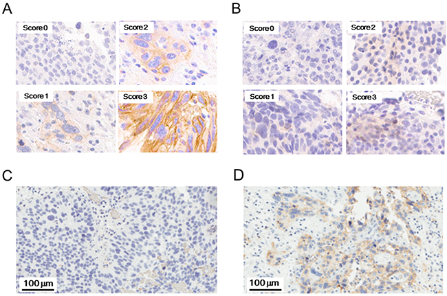 Representative staining patterns of PD-L1 and PD-L2.