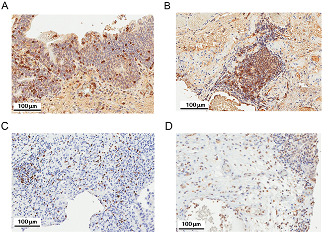 Representative staining patterns of CD8, FOXP3, and CD69.