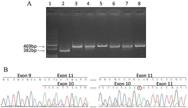 Splicing mutation c.1095G&#x003E;T in CHEK2.