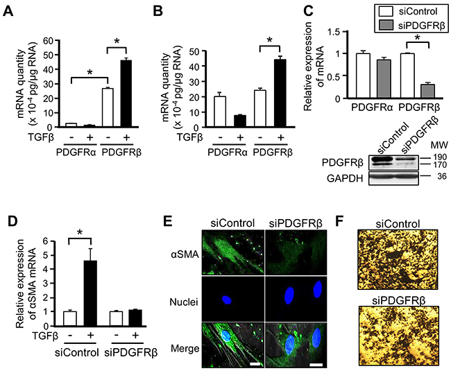 PDGFR&#x03B2; is involved in the differentiation of mesenchymal stem cells (MSCs) into cancer-associated fibroblasts.