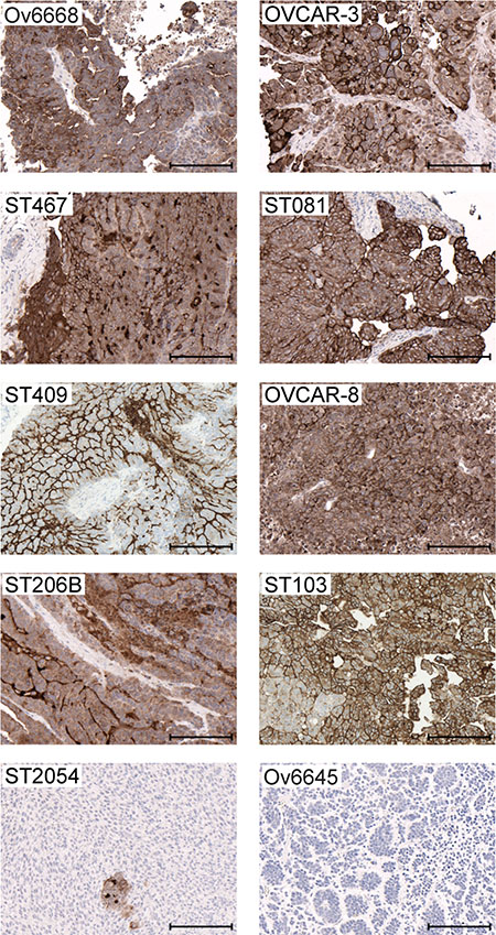 Mesothelin expression in ovarian cancer cell line- and patient-derived xenograft models.