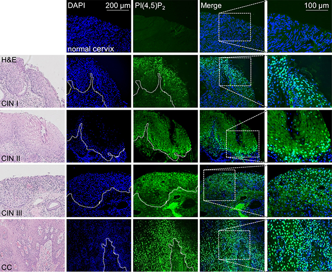 Enhanced nuclear PI(4,5)P2 levels in HPV16 positive cervical tumors.