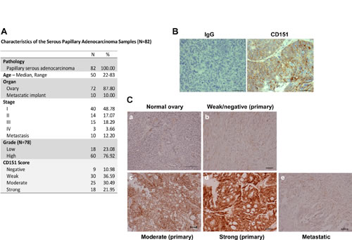 CD151 expression in human serous-type ovarian tumors.