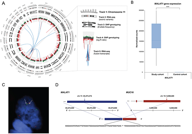 Genomic rearrangements for ovarian sample OV315, MALAT1 gene expression pattern, and FISH validated fusion transcript.