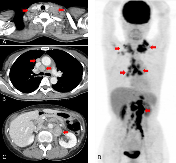 Computed tomography (CT) and [18F]-fluorodeoxyglucose (FDG) positron emission tomography (PET) before treatment.