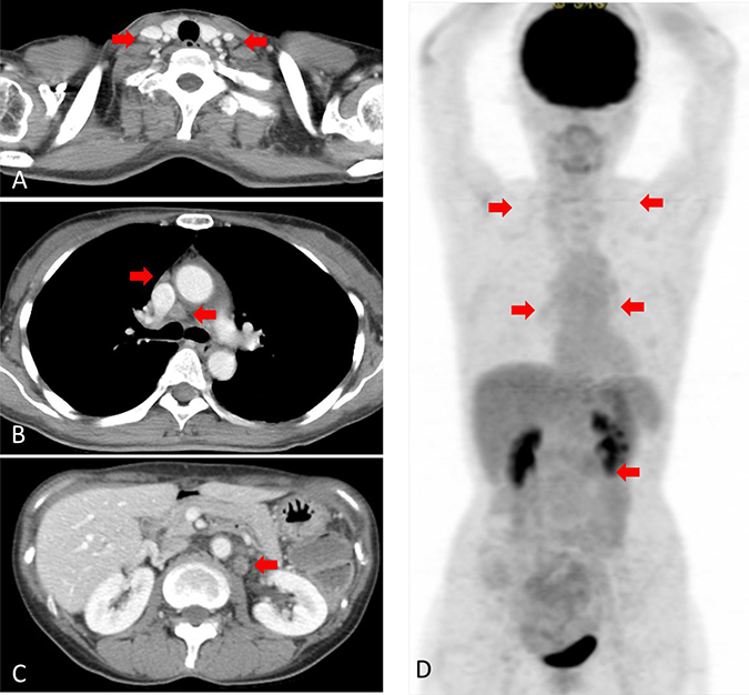 Computed tomography (CT) and [18F]-fluorodeoxyglucose (FDG) positron emission tomography (PET) after treatment.