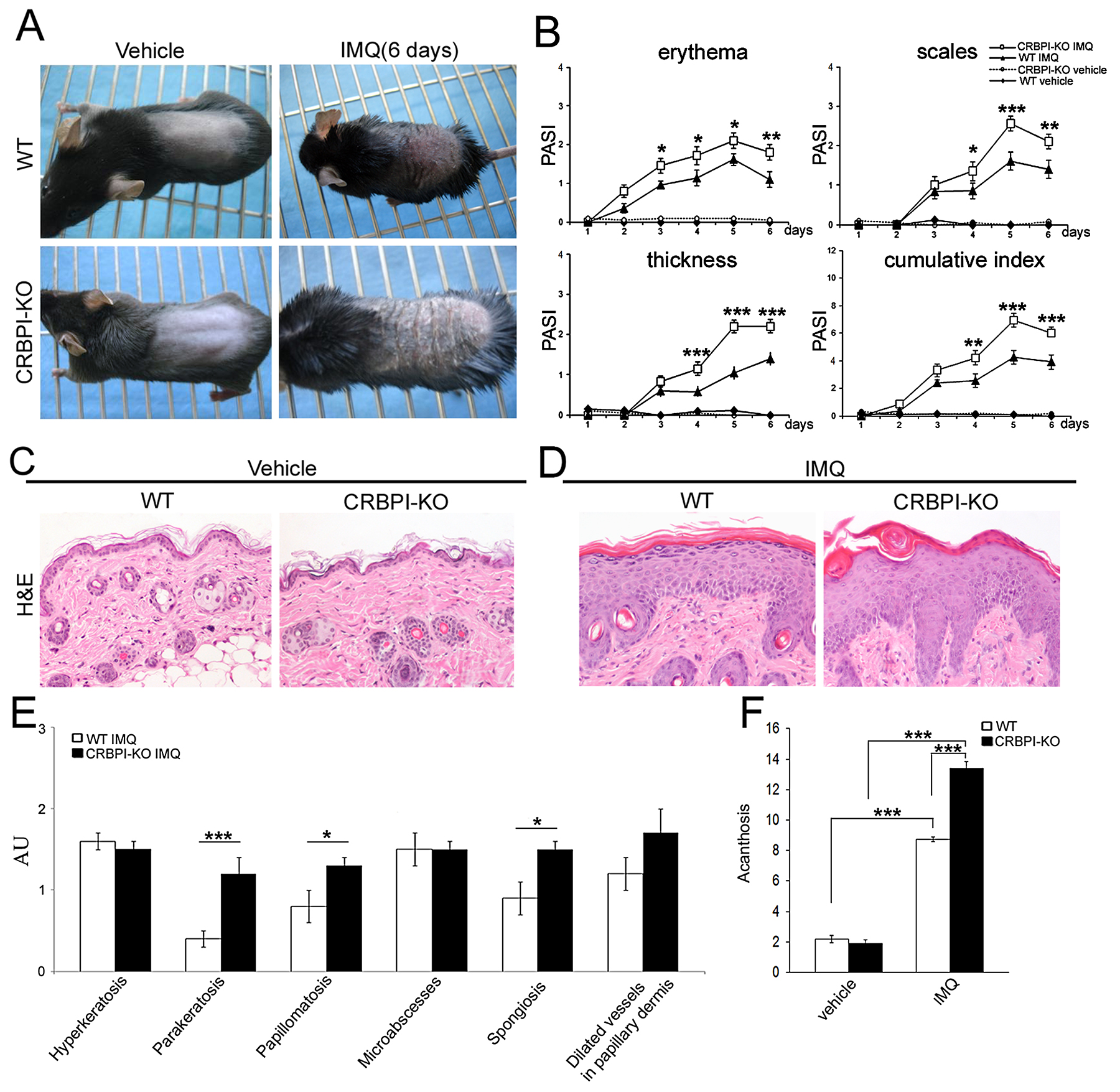 Imiquimod treatment induces more severe psoriasis-like lesions in CRBPI-knockout mice.