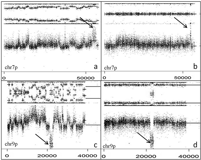 EGFR amplification and CDKN2A deletion with or without CT.