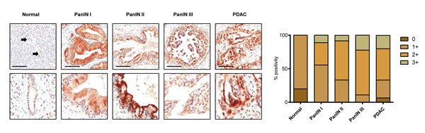 Representative images of ANGPTL2 expression in normal pancreatic parenchyma, PanIN lesions and PDAC.