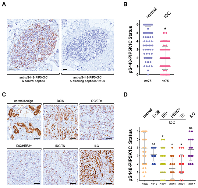Phosphorylation of PIP5K1C at S448 is decreased in invasive ductal carcinoma of the breast.