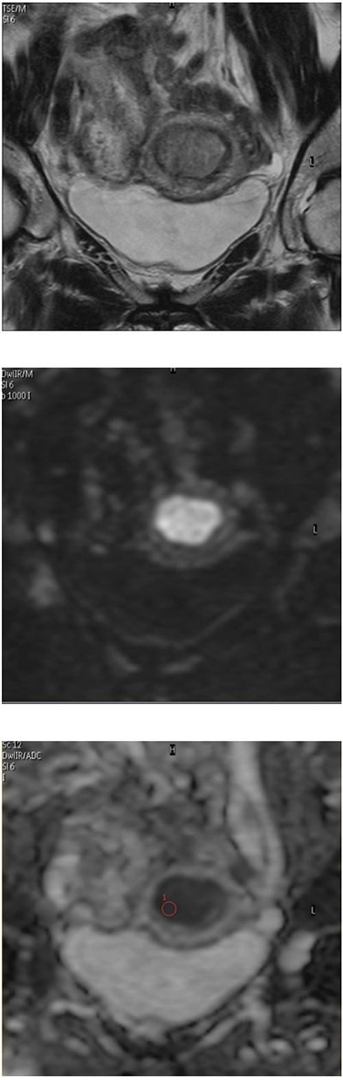 Apparent diffusion coefficient (ADC) analyses of endometrial lesions.