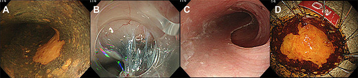 Endoscopic submucosal dissection (ESD) of esophageal neoplasia: a representative procedure.