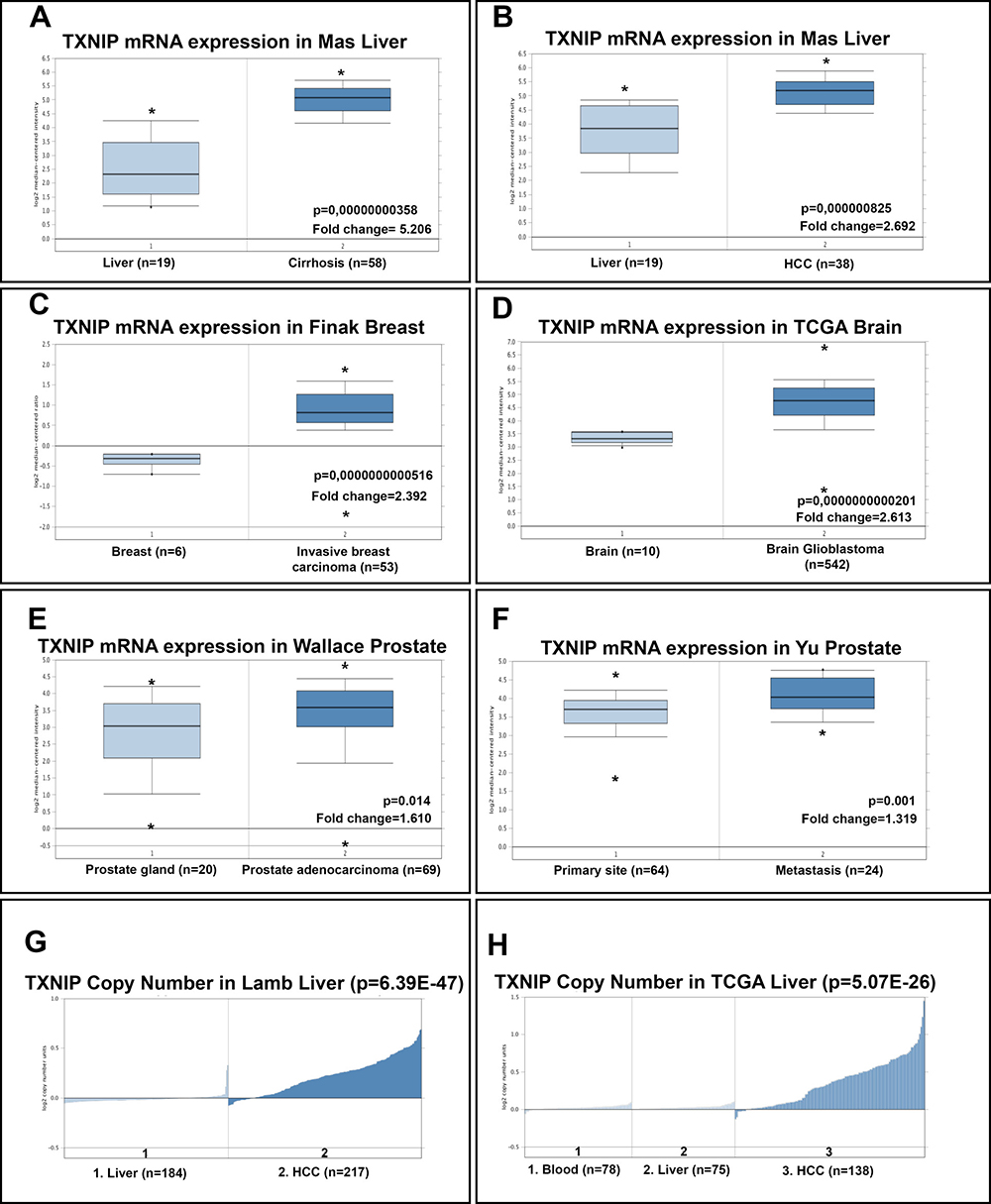 Oncomine analysis of TXNIP mRNA levels and copy number of TXNIP gene in cancer versus normal tissues.
