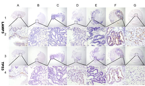 Representation of LAMP3 and TP53 protein expression in gastric benign and malignant tissues on TMA sections.