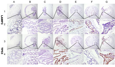 Representation of LAMP3 and TP53 protein expression in colorectal benign and malignant tissues on TMA sections.