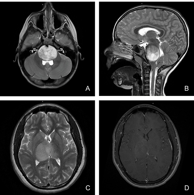 Magnetic resonance imaging characteristics (MRI) of pediatric diffuse midline glioma.