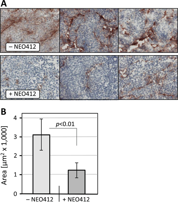 Microvessel density in melanoma tissue.