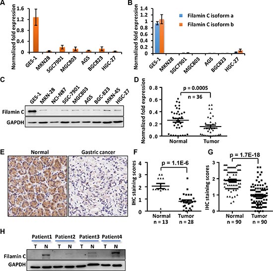 The mRNA and protein levels of filamin C were significantly reduced in GC cell lines and GC tissues compared with the gastric cell line and corresponding normal gastric tissues.