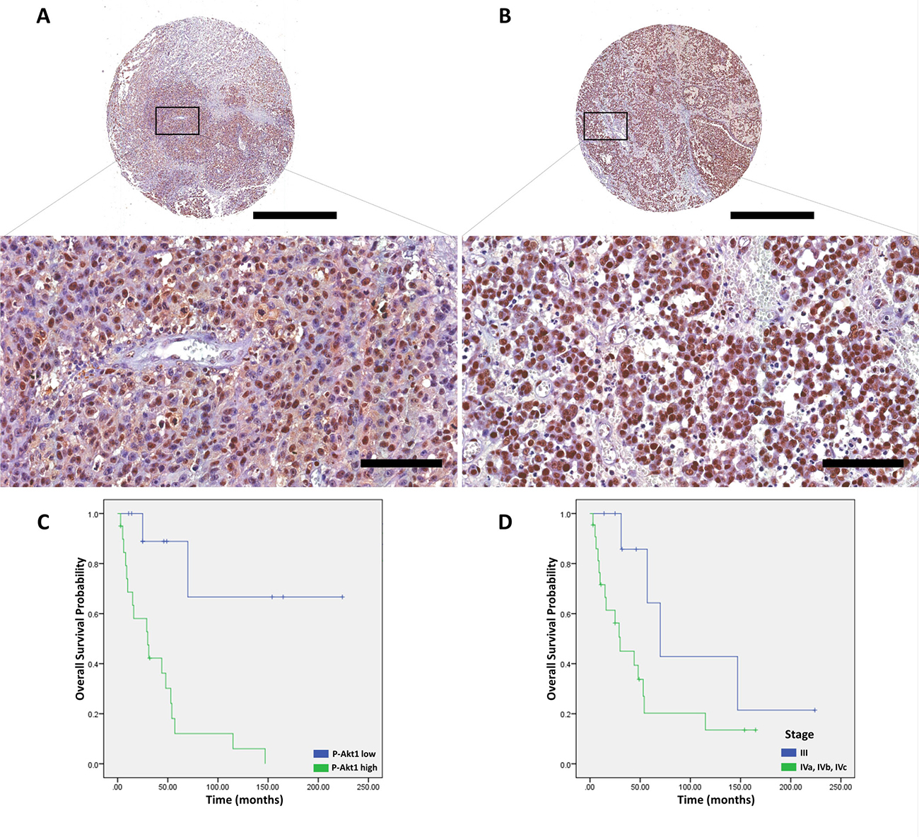 p-Akt1 expression in sinonasal melanomas.