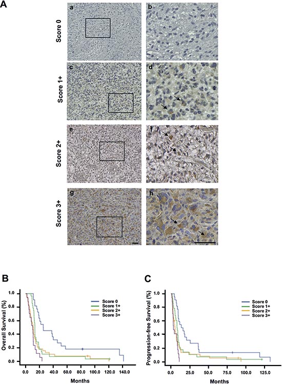 Prognostic relevance of EB1 expression in glioblastoma.