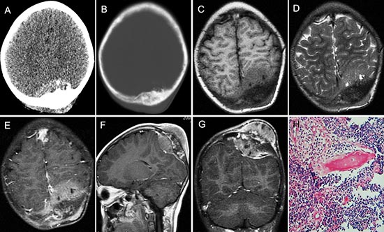 pPNET in an 11-year-old girl.