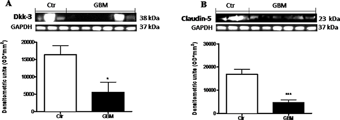 Role of Dkk-3 and claudin-5 in human GBM cells.