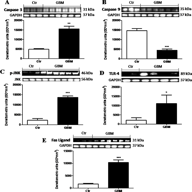 The role of Dkk-3 and TLR-4 pathway activation in the pathogenesis of GBM.