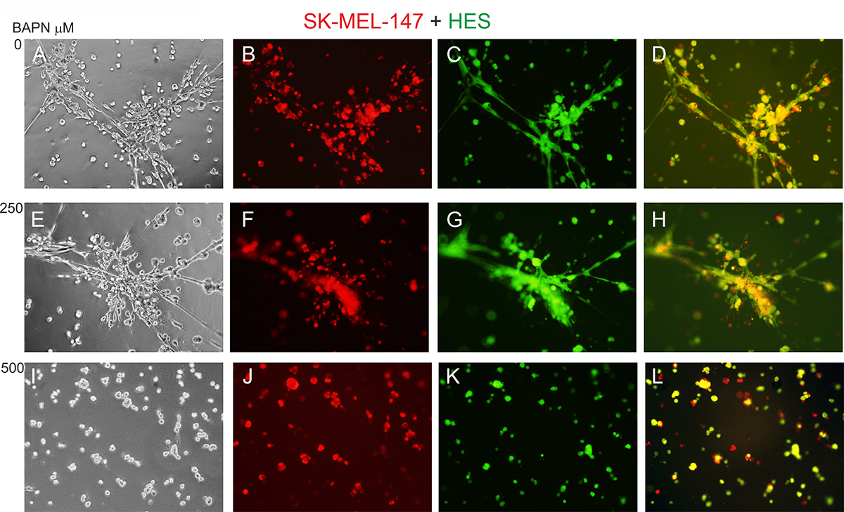 Effect of LOX inhibitor BAPN on the invasive growth of co-cultured SK-MEL-147 melanoma cells and HES cells.