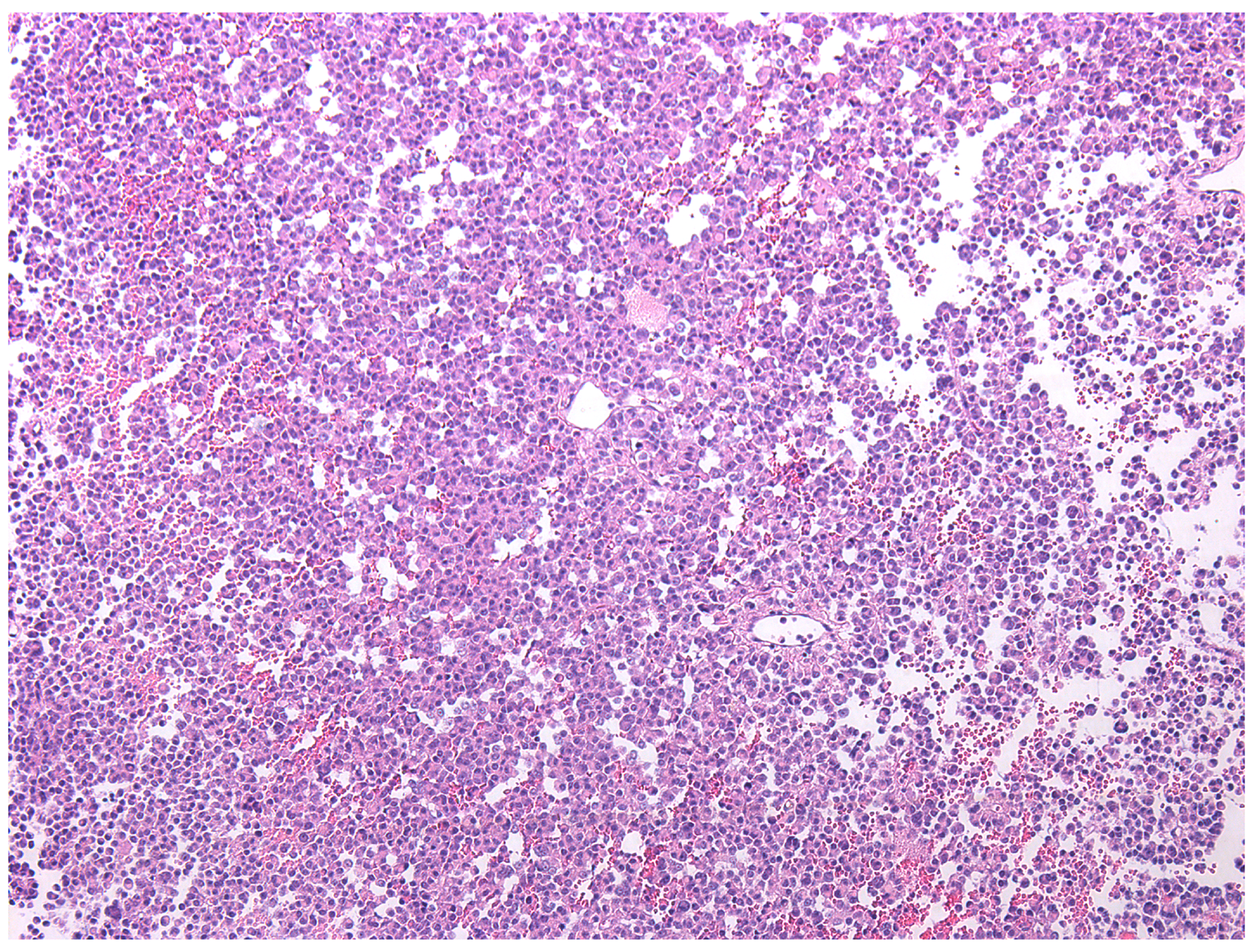 Plurihormonal pituitary adenoma with trabecular structure, hematoxylin and eosin, &#x00D7;100.