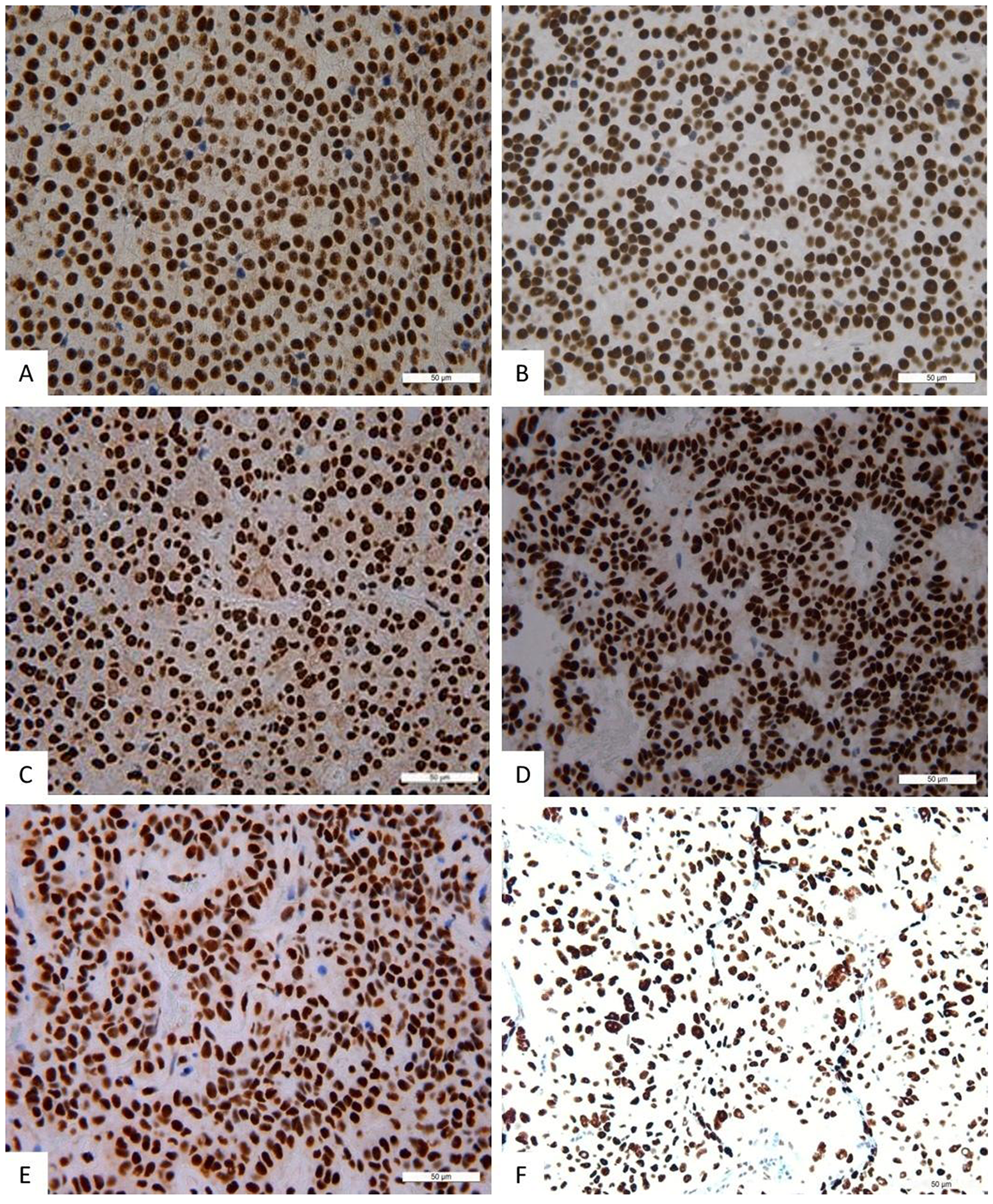 Immunohistochemistry, NeuroD1 in different pituitary adenomas.