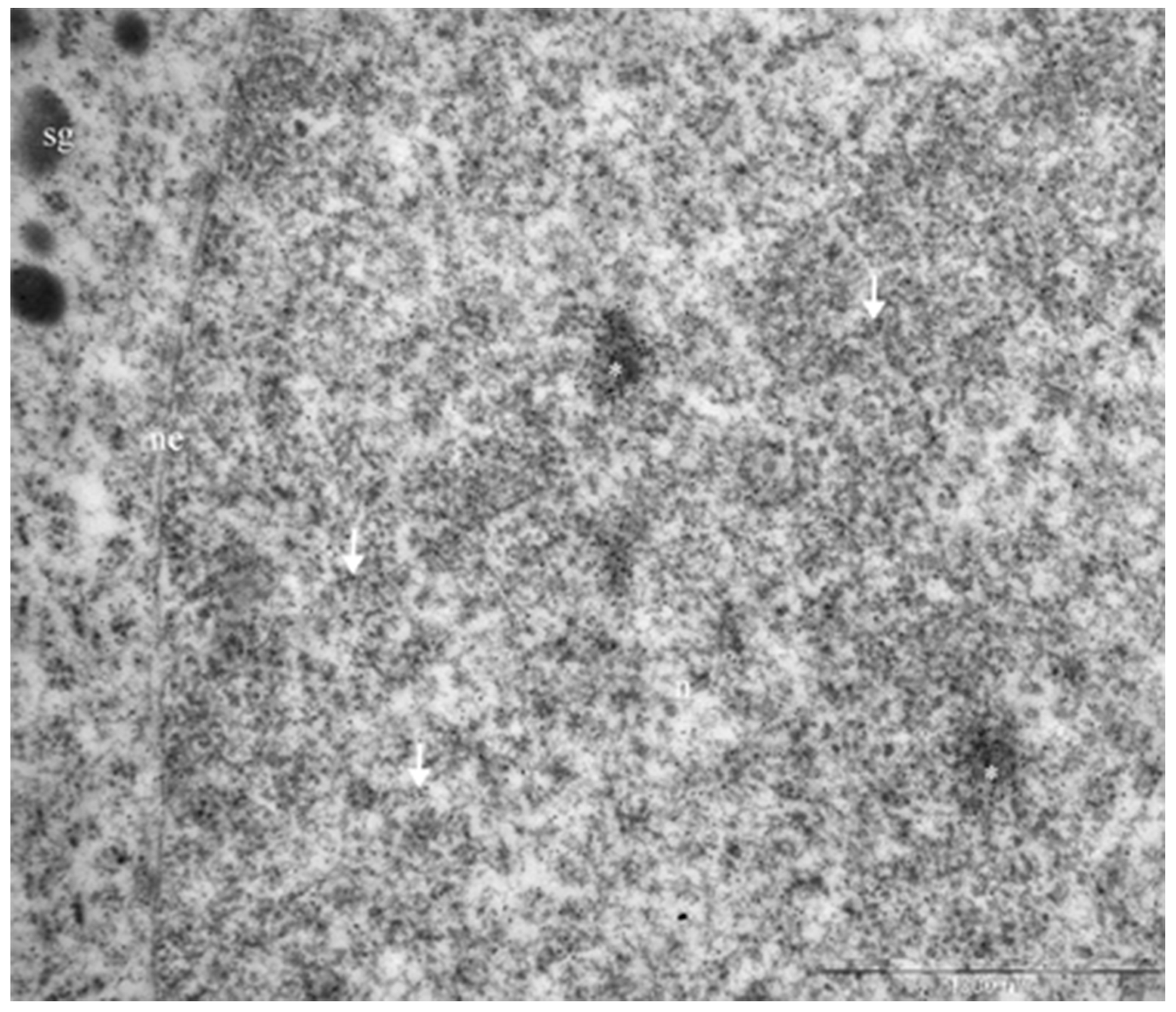 Immunogold labeling of Neuro D1, mammosomatotropinoma cell nucleus.