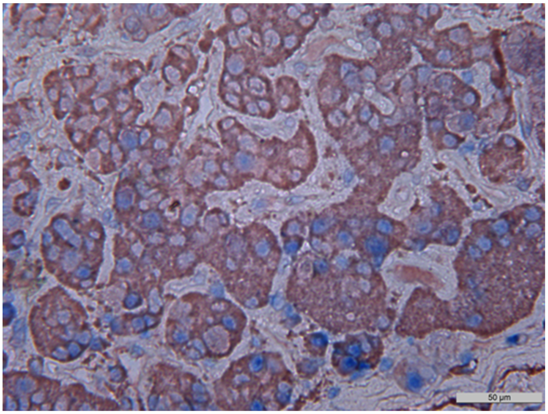 Double stain immunohistochemistry, normal anterior pituitary, Growth hormone/NeuroD1, &#x00D7;400.