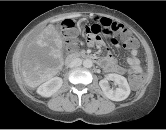 CT scan of the abdomen and pelvis with intravenous contrast showing multiple masses throughout the liver, later biopsy-proven hepatic angiosarcoma.