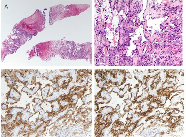 Histologic and immunohistochemical analysis of the liver tumor.