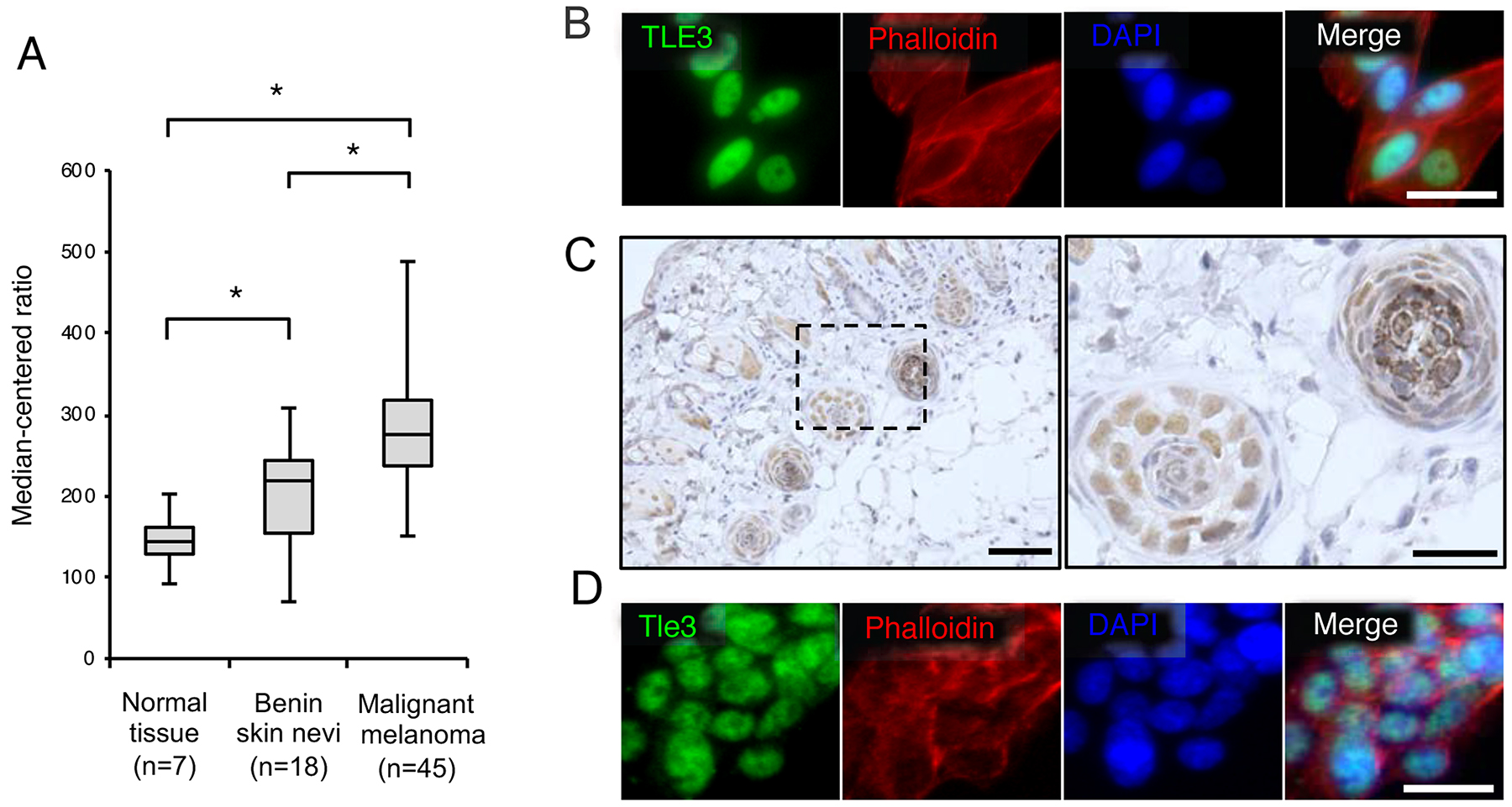 The expression levels of TLE3 are increased in human malignant melanoma.