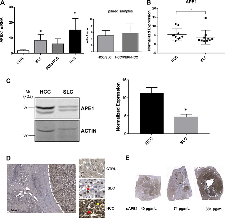 APE1 expression in HCC tissues.