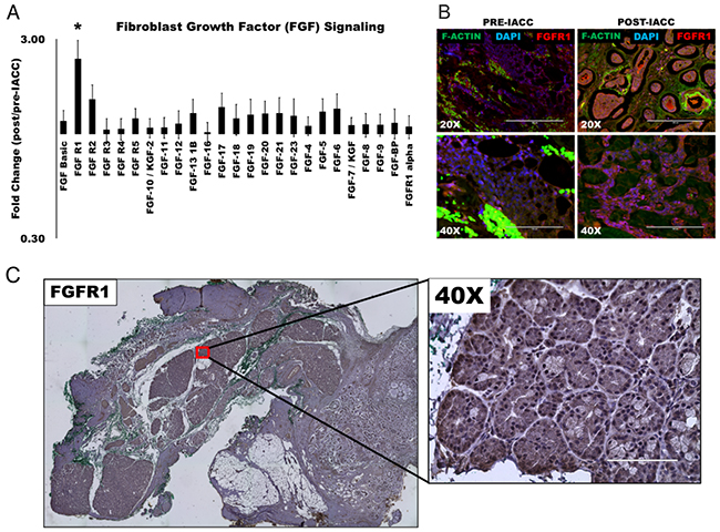 Fibroblast growth factor (FGF) signaling is upregulated following IACC in LGACC tumors.