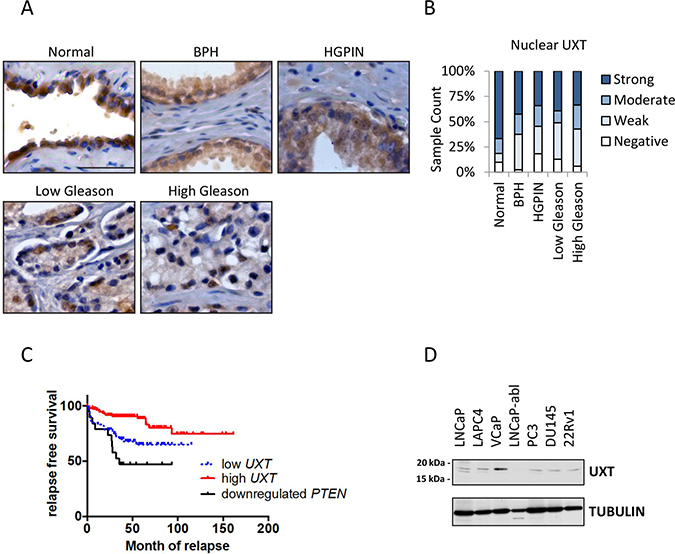 Loss of UXT expression in prostate cancer progression.