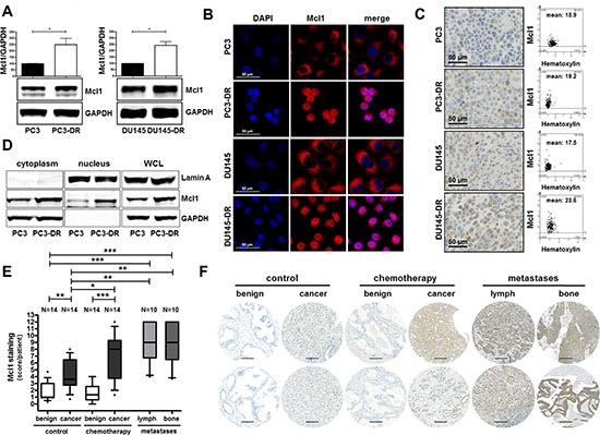 Mcl1 protein expression is elevated in docetaxel resistant cell lines, in prostate cancer, in metastatic lesions, and in patients after docetaxel chemotherapy.