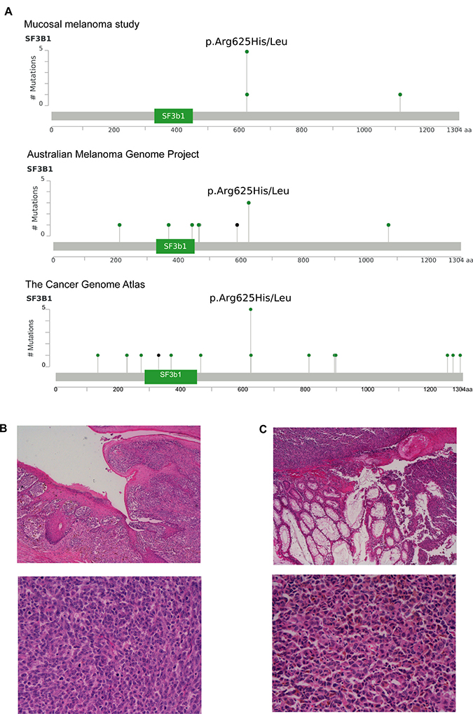 Recurrent hotspot SF3B1 R625 mutations and co-occurrence mutation events in mucosal melanoma.