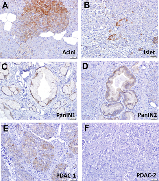 DEPTOR expression is gradually lost during human pancreatic tumorigenesis.