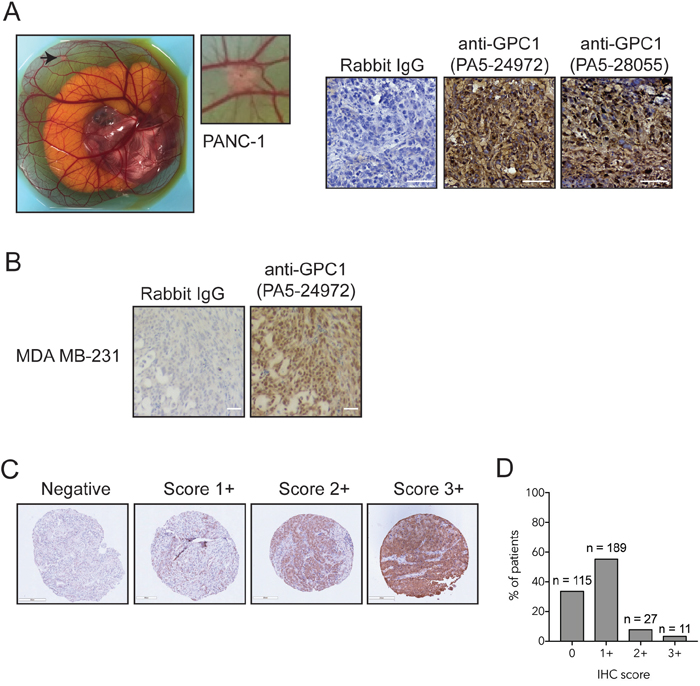 GPC1 expression in tissue microarray of human PDAC.