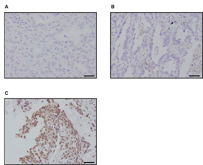 Immunohistochemistry of p22phox in patients with lung adenocarcinoma.