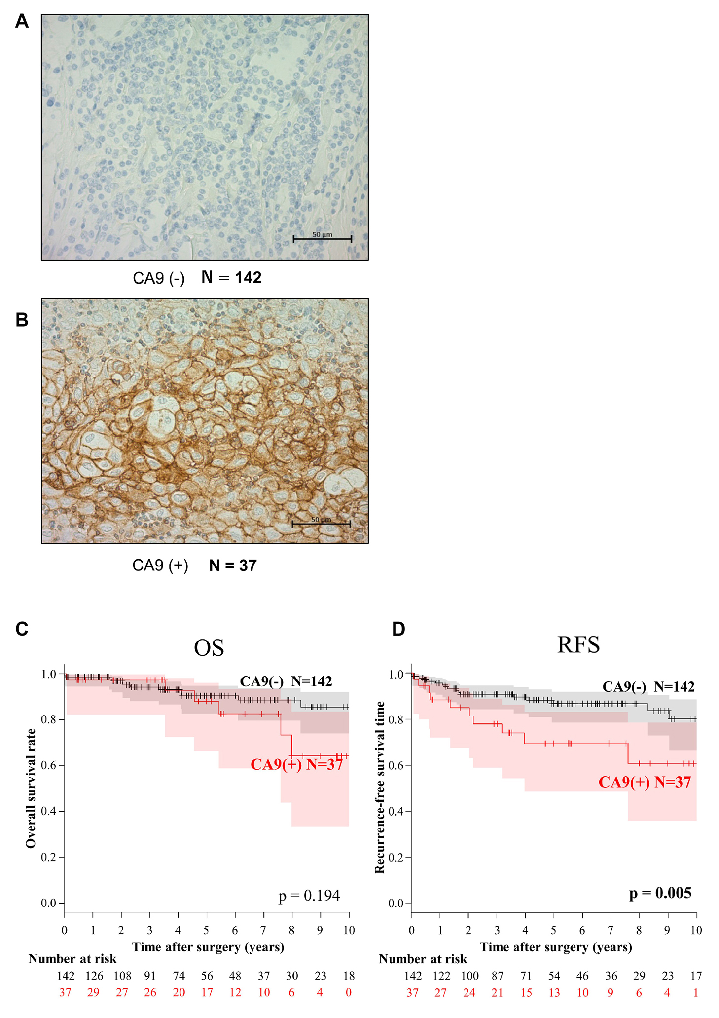 Immunohistochemical analysis of CA9 expression and the association of CA9 expression with overall survival (OS) and recurrence-free survival (RFS) of patients with thymic epithelial tumors.