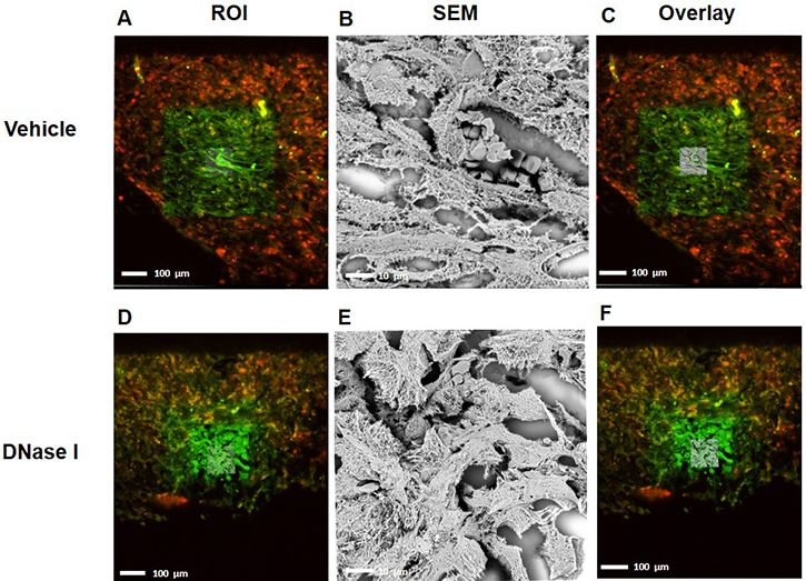 CLEM images indicating that NETs co-localized with murine colon cancer metastasis tissue.