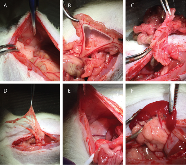 Macroscopic peritoneal tumor nodules found during laparotomy.