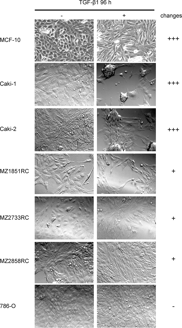 Morphology changes of RCC cell lines and MCF-10 after TGF-&#x03B2;1 treatment.
